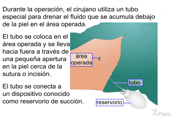 Durante la operacin, el cirujano utiliza un tubo especial para drenar el fluido que se acumula debajo de la piel en el rea operada. El tubo se coloca en el rea operada y se lleva hacia fuera a travs de una pequea apertura en la piel cerca de la sutura o incisin. El tubo se conecta a un dispositivo conocido como reservorio de succin.