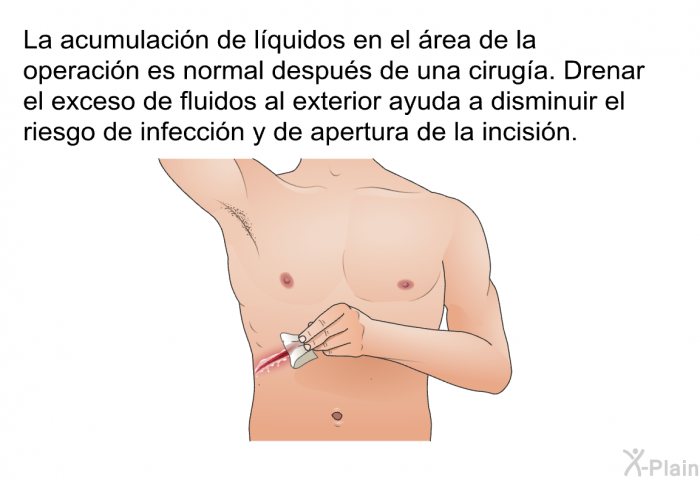 La acumulacin de lquidos en el rea de la operacin es normal despus de una ciruga. Drenar el exceso de fluidos al exterior ayuda a disminuir el riesgo de infeccin y de apertura de la incisin.