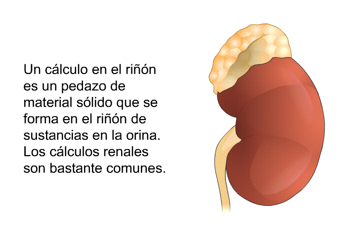 Un clculo en el rin es un pedazo de material slido que se forma en el rin de sustancias en la orina. Los clculos renales son bastante comunes.