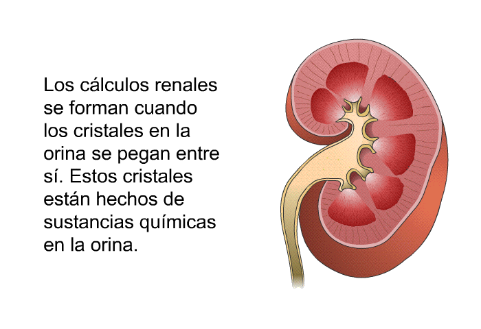 Los clculos renales se forman cuando los cristales en la orina se pegan entre s. Estos cristales estn hechos de sustancias qumicas en la orina.