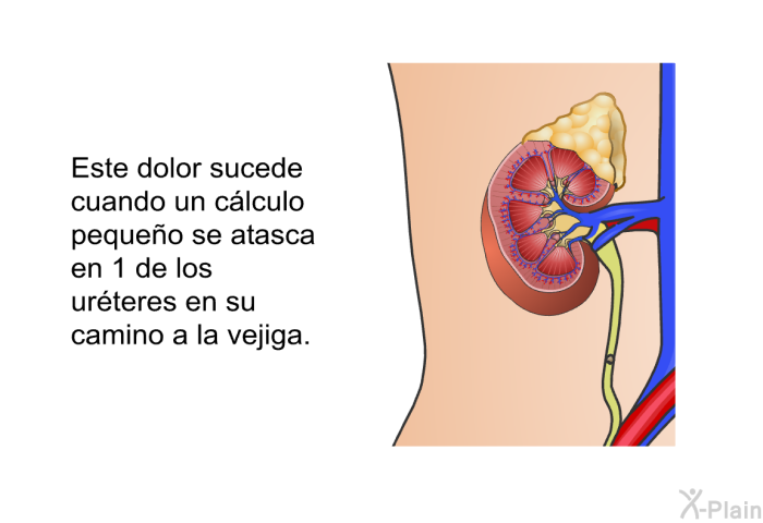 Este dolor sucede cuando un c�lculo peque�o se atasca en 1 de los ur�teres en su camino a la vejiga.
