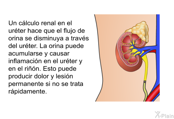 Un c�lculo renal en el ur�ter hace que el flujo de orina se disminuya a trav�s del ur�ter. La orina puede acumularse y causar inflamaci�n en el ur�ter y en el ri��n. Esto puede producir dolor y lesi�n permanente si no se trata r�pidamente.