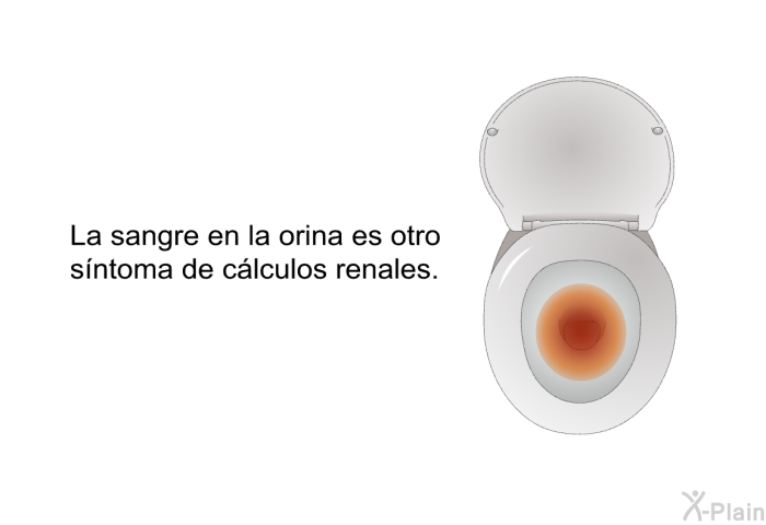 La sangre en la orina es otro s�ntoma de c�lculos renales.