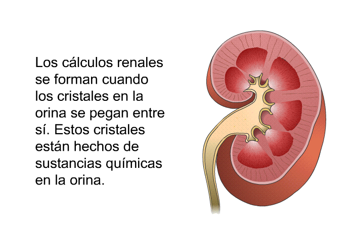 Los c�lculos renales se forman cuando los cristales en la orina se pegan entre s�. Estos cristales est�n hechos de sustancias qu�micas en la orina.