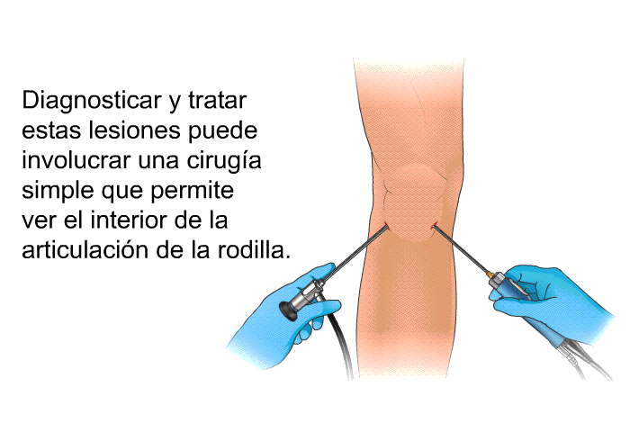 Diagnosticar y tratar estas lesiones puede involucrar una ciruga simple que permite ver el interior de la articulacin de la rodilla.