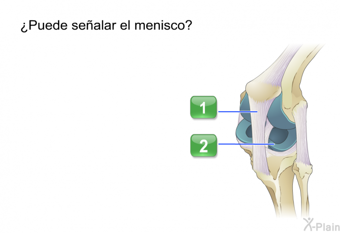 ¿Puede sealar el menisco?