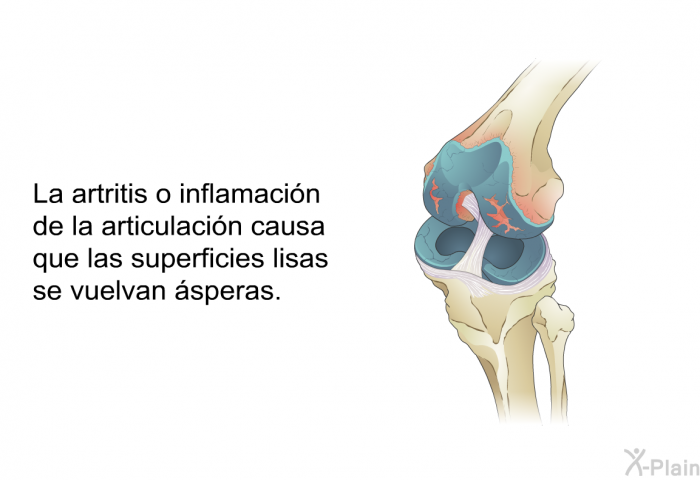 La artritis o inflamacin de la articulacin causa que las superficies lisas se vuelvan speras.