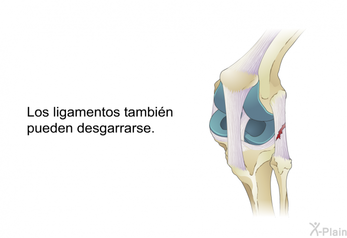 Los ligamentos tambin pueden desgarrarse.