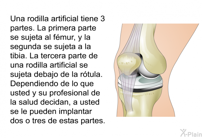 Una rodilla artificial tiene 3 partes. La primera parte se sujeta al fmur, y la segunda se sujeta a la tibia. La tercera parte de una rodilla artificial se sujeta debajo de la rtula. Dependiendo de lo que usted y su profesional de la salud decidan, a usted se le pueden implantar dos o tres de estas partes.