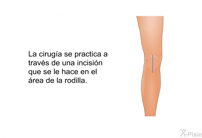 La ciruga se practica a travs de una incisin que se le hace en el rea de la rodilla.