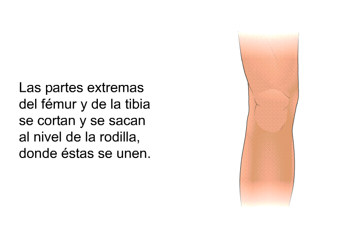 Las partes extremas del fmur y de la tibia se cortan y se sacan al nivel de la rodilla, donde stas se unen.