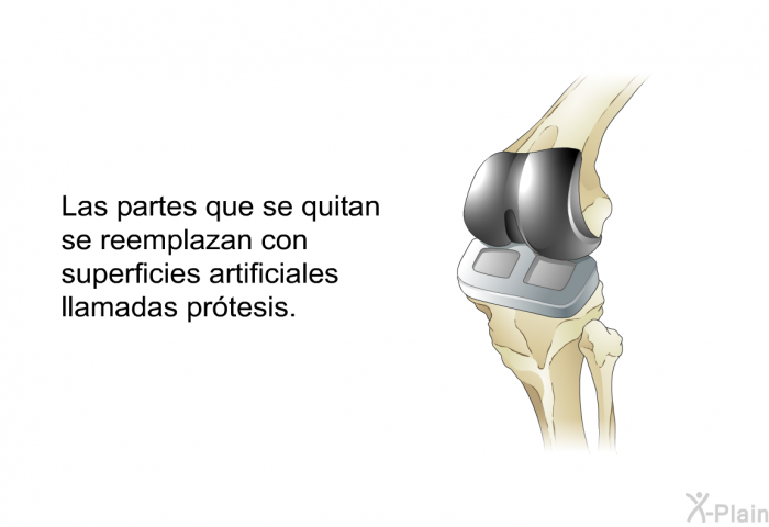 Las partes que se quitan se reemplazan con superficies artificiales llamadas prtesis.