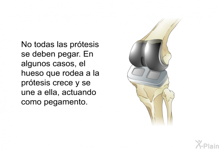 No todas las prtesis se deben pegar. En algunos casos, el hueso que rodea a la prtesis crece y se une a ella, actuando como pegamento.