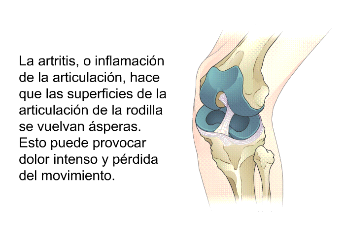 La artritis, o inflamacin de la articulacin, hace que las superficies de la articulacin de la rodilla se vuelvan speras. Esto puede provocar dolor intenso y prdida del movimiento.