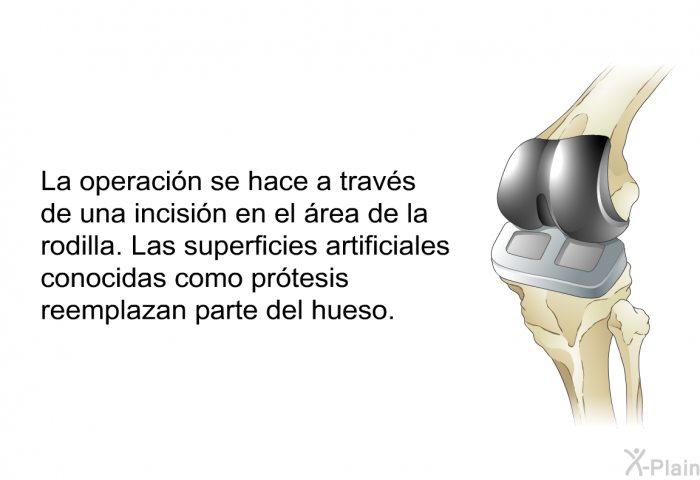 La operaci�n se hace a trav�s de una incisi�n en el �rea de la rodilla. Las superficies artificiales conocidas como pr�tesis reemplazan parte del hueso.