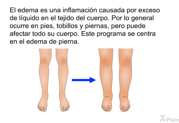 El edema es una inflamacin causada por exceso de lquido en el tejido del cuerpo. Por lo general ocurre en pies, tobillos y piernas, pero puede afectar todo su cuerpo. Esta informacin acerca de su salud se centra en el edema de pierna.