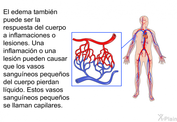 El edema tambin puede ser la respuesta del cuerpo a inflamaciones o lesiones. Una inflamacin o una lesin pueden causar que los vasos sanguneos pequeos del cuerpo pierdan lquido. Estos vasos sanguneos pequeos se llaman capilares.