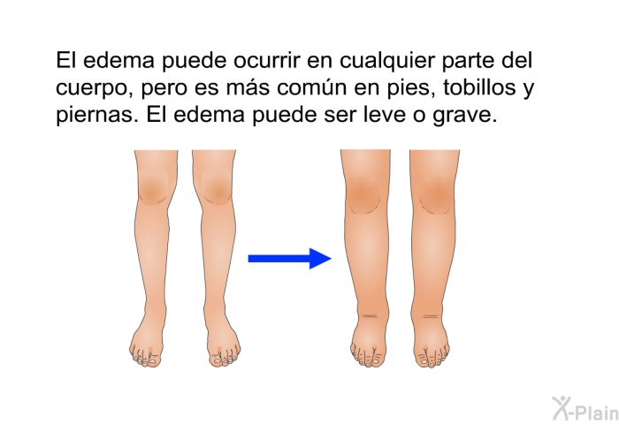 El edema puede ocurrir en cualquier parte del cuerpo, pero es ms comn en pies, tobillos y piernas. El edema puede ser leve o grave.