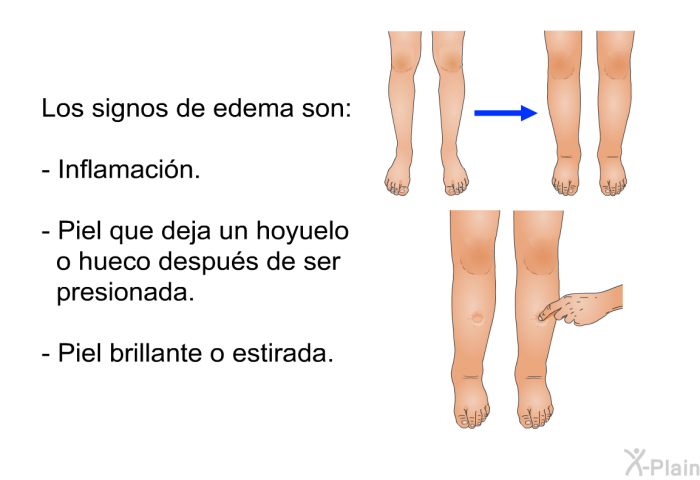 Los signos de edema son:  Inflamacin. Piel que deja un hoyuelo o hueco despus de ser presionada. Piel brillante o estirada.