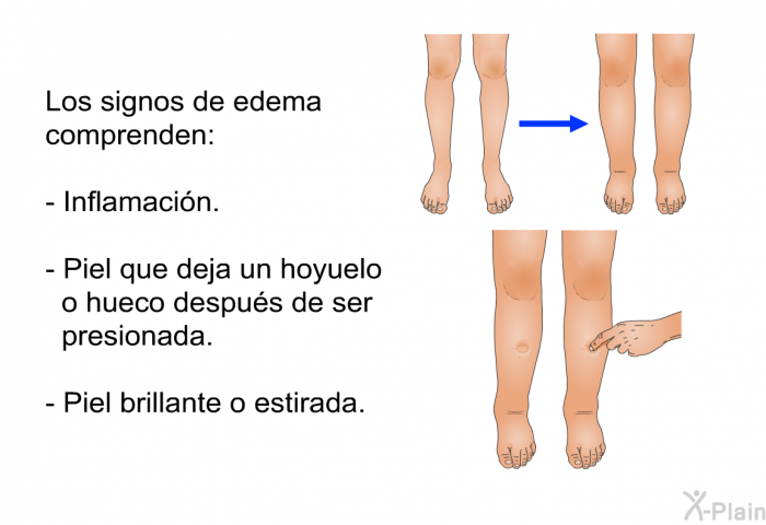 Los signos de edema comprenden:  Inflamaci�n. Piel que deja un hoyuelo o hueco despu�s de ser presionada. Piel brillante o estirada.