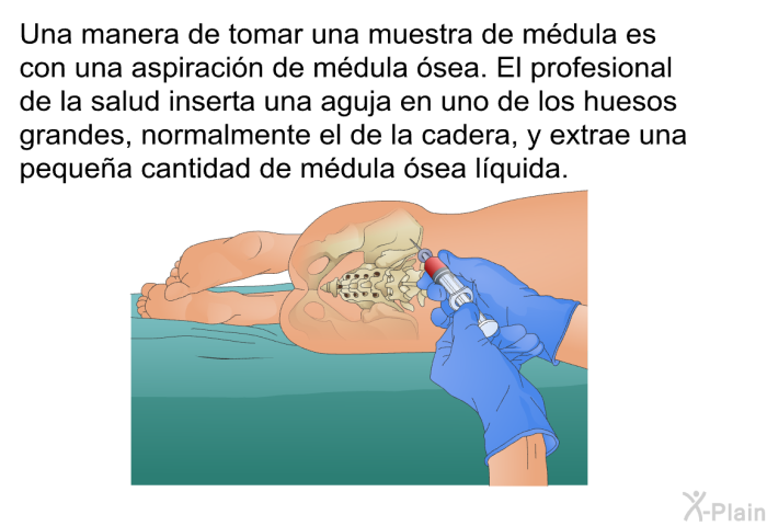Una manera de tomar una muestra de m�dula es con una <I>aspiraci�n de m�dula �sea</I>. El profesional de la salud inserta una aguja en uno de los huesos grandes, normalmente el de la cadera, y extrae una peque�a cantidad de m�dula �sea l�quida.
