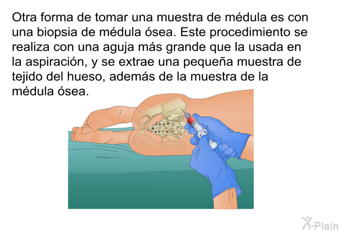 Otra forma de tomar una muestra de m�dula es con una <I>biopsia de m�dula �sea</I>. Este procedimiento se realiza con una aguja m�s grande que la usada en la aspiraci�n, y se extrae una peque�a muestra de tejido del hueso, adem�s de la muestra de la m�dula �sea.