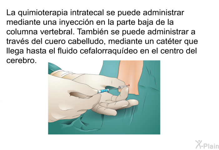 La quimioterapia intratecal se puede administrar mediante una inyeccin en la parte baja de la columna vertebral. Tambin se puede administrar a travs del cuero cabelludo, mediante un catter que llega hasta el fluido cefalorraqudeo en el centro del cerebro.