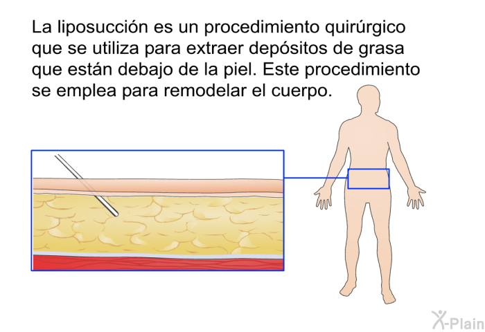 La liposuccin es un procedimiento quirrgico que se utiliza para extraer depsitos de grasa que estn debajo de la piel. Este procedimiento se emplea para remodelar el cuerpo.