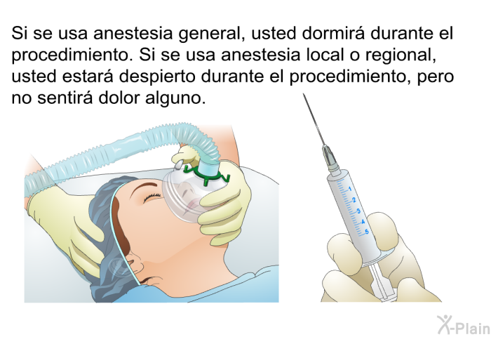 Si se usa anestesia general, usted dormir durante el procedimiento. Si se usa anestesia local o regional, usted estar despierto durante el procedimiento, pero no sentir dolor alguno.
