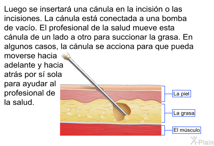 Luego se insertar una cnula en la incisin o las incisiones. La cnula est conectada a una bomba de vaco. El profesional de la salud mueve esta cnula de un lado a otro para succionar la grasa. En algunos casos, la cnula se acciona para que pueda moverse hacia adelante y hacia atrs por s sola para ayudar al profesional de la salud.