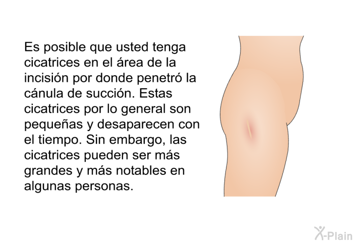 Es posible que usted tenga cicatrices en el rea de la incisin por donde penetr la cnula de succin. Estas cicatrices por lo general son pequeas y desaparecen con el tiempo. Sin embargo, las cicatrices pueden ser ms grandes y ms notables en algunas personas.