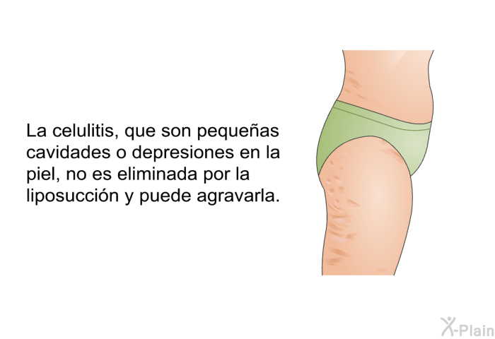 La celulitis, que son pequeas cavidades o depresiones en la piel, no es eliminada por la liposuccin y puede agravarla.