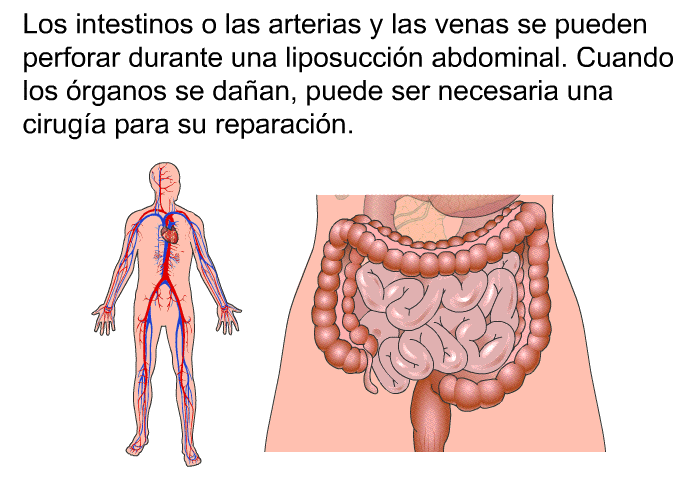 Los intestinos o las arterias y las venas se pueden perforar durante una liposuccin abdominal. Cuando los rganos se daan, puede ser necesaria una ciruga para su reparacin.