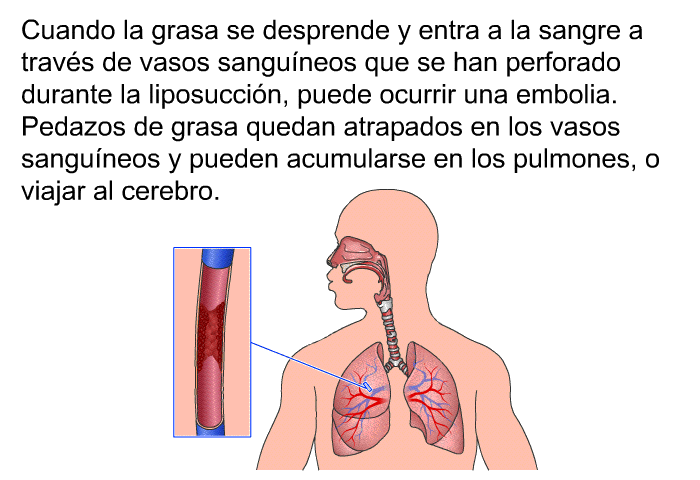 Cuando la grasa se desprende y entra a la sangre a travs de vasos sanguneos que se han perforado durante la liposuccin, puede ocurrir una embolia. Pedazos de grasa quedan atrapados en los vasos sanguneos y pueden acumularse en los pulmones, o viajar al cerebro.