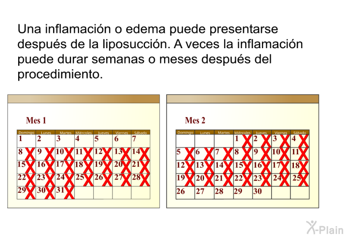 Una inflamacin o edema puede presentarse despus de la liposuccin. A veces la inflamacin puede durar semanas o meses despus del procedimiento.