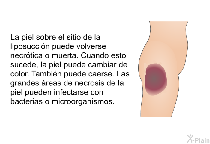 La piel sobre el sitio de la liposuccin puede volverse necrtica o muerta. Cuando esto sucede, la piel puede cambiar de color. Tambin puede caerse. Las grandes reas de necrosis de la piel pueden infectarse con bacterias o microorganismos.