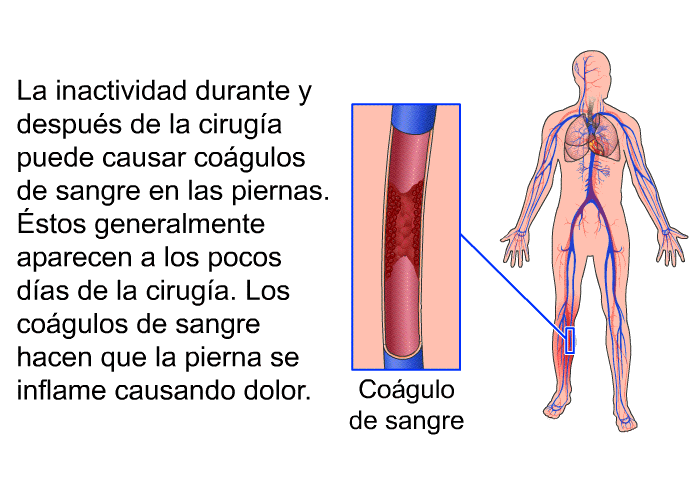 La inactividad durante y despus de la ciruga puede causar cogulos de sangre en las piernas. Éstos generalmente aparecen a los pocos das de la ciruga. Los cogulos de sangre hacen que la pierna se inflame causando dolor.