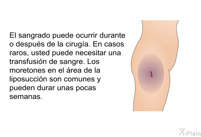 El sangrado puede ocurrir durante o despus de la ciruga. En casos raros, usted puede necesitar una transfusin de sangre. Los moretones en el rea de la liposuccin son comunes y pueden durar unas pocas semanas.