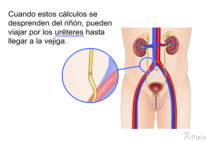 Cuando estos clculos se desprenden del rin, pueden viajar por los urteres hasta llegar a la vejiga.