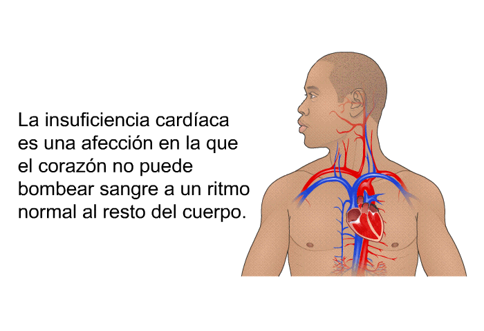 La insuficiencia cardaca es una afeccin en la que el corazn no puede bombear sangre a un ritmo normal al resto del cuerpo.