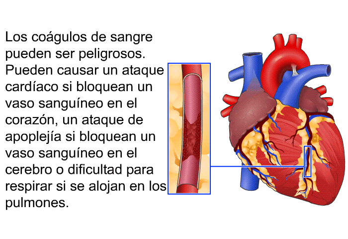 Los cogulos de sangre pueden ser peligrosos. Pueden causar un ataque cardaco si bloquean un vaso sanguneo en el corazn, un ataque de apopleja si bloquean un vaso sanguneo en el cerebro o dificultad para respirar si se alojan en los pulmones.