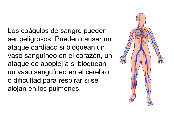 Los cogulos de sangre pueden ser peligrosos. Pueden causar un ataque cardaco si bloquean un vaso sanguneo en el corazn, un ataque de apopleja si bloquean un vaso sanguneo en el cerebro o dificultad para respirar si se alojan en los pulmones.