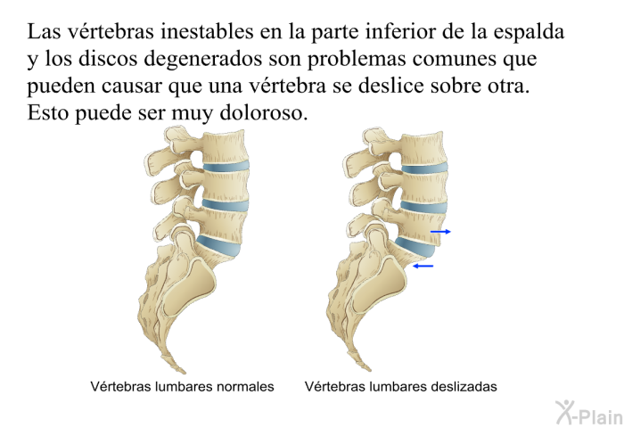 Las vrtebras inestables en la parte inferior de la espalda y los discos degenerados son problemas comunes que pueden causar que una vrtebra se deslice sobre otra. Esto puede ser muy doloroso.