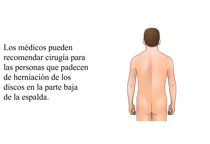 Los mdicos pueden recomendar ciruga para las personas que padecen de herniacin de los discos en la parte baja de la espalda.