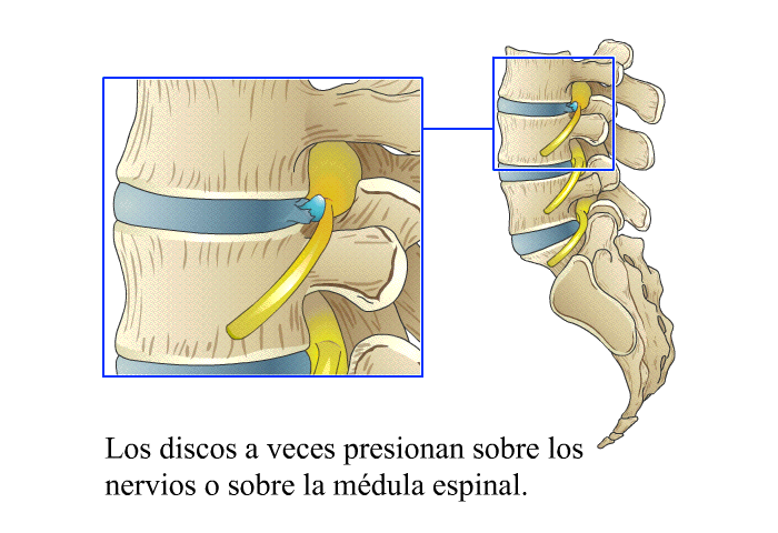 Los discos a veces presionan sobre los nervios o sobre la mdula espinal.