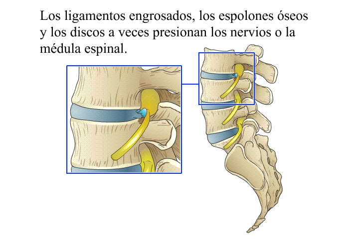 Los ligamentos engrosados, los espolones seos y los discos a veces presionan los nervios o la mdula espinal.