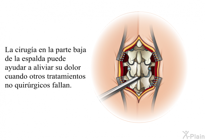 La ciruga en la parte baja de la espalda puede ayudar a aliviar su dolor cuando otros tratamientos no quirrgicos fallan.