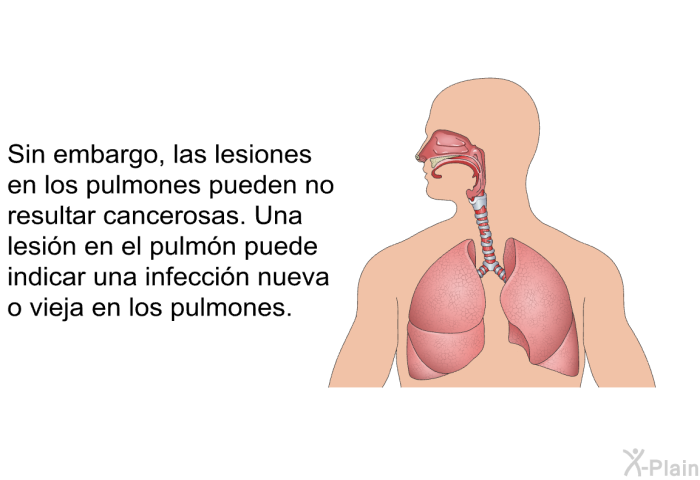 Sin embargo, las lesiones en los pulmones pueden no resultar cancerosas. Una lesin en el pulmn puede indicar una infeccin nueva o vieja en los pulmones.