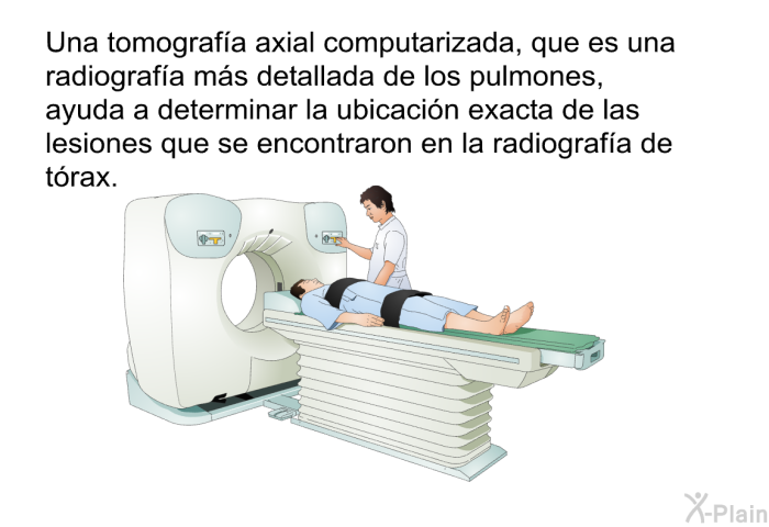 Una tomografa axial computarizada, que es una radiografa ms detallada de los pulmones, ayuda a determinar la ubicacin exacta de las lesiones que se encontraron en la radiografa de trax.