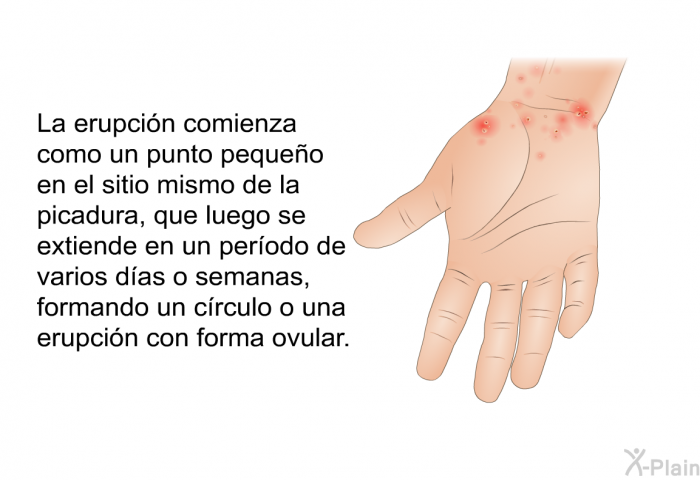 La erupcin comienza como un punto pequeo en el sitio mismo de la picadura, que luego se extiende en un perodo de varios das o semanas, formando un crculo o una erupcin con forma ovular.